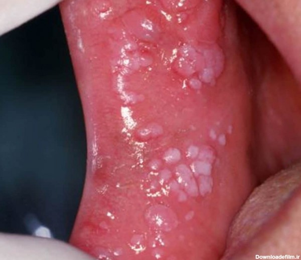 تشخیص زگیل تناسلی در دهان و گلو