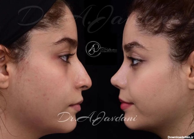 تصاویر قبل و بعد عمل بینی | دکتر علی جاودانی(صفحه2)