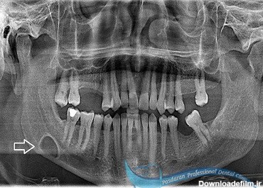 کیستهای دندانی و فکی + تشخیص و درمان
