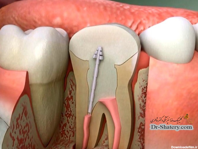 عصب کشی دندان درمان ریشه دکتر کامیار شاطری دندان پزشکی گیشا روت ...