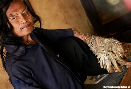 مرد درختی اندونزی در حسرت داشتن همسر فوت کرد+عکس