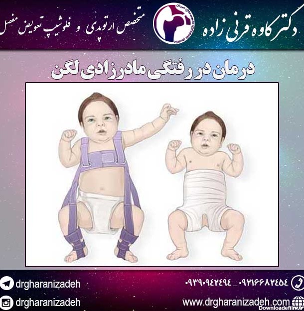 عکس در رفتگی مادرزادی لگن