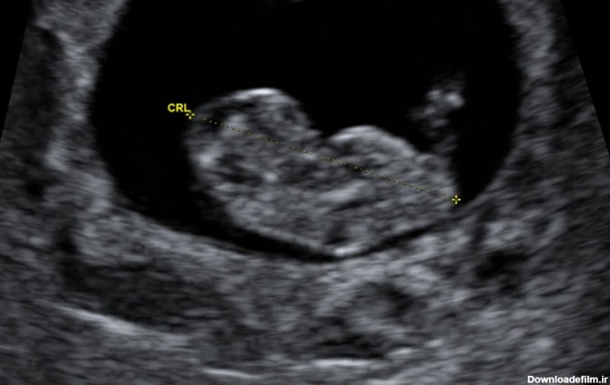 در سونوگرافی هفته 8 بارداری جنین شبیه به یک لوبیا دیده می‌شود.