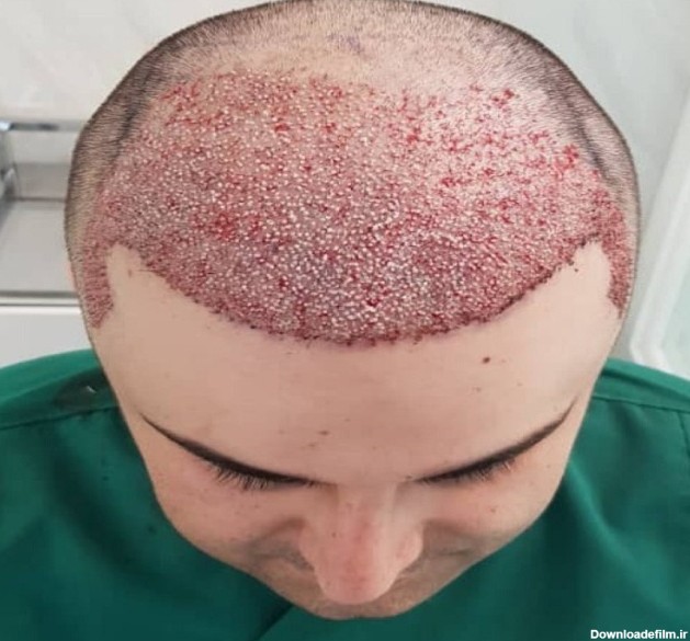 کاشت مو با استفاده از هیپنوتیزم در مشهد انجام شد - درمانگاه ...