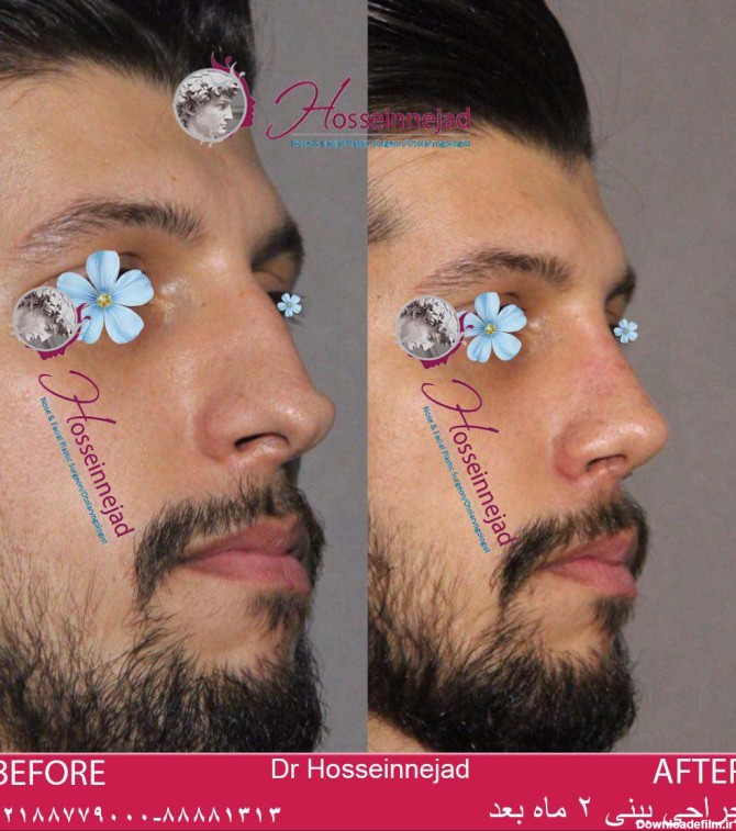 جراحی بینی مردان|جراحی بینی طبیعی مردان| تفاوت های جراحی بینی ...