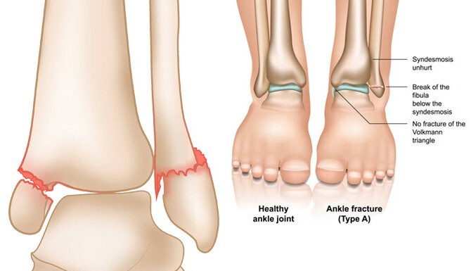 پزشک متخصص چگونه شکستگی مچ پا را تشخیص می‌دهد؟ - خبرآنلاین