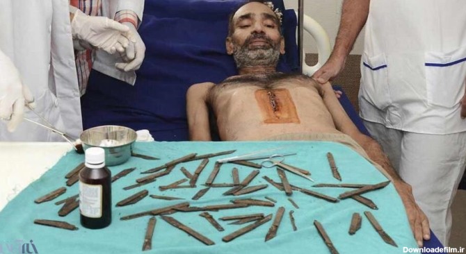 عکس | جراحی ۵ ساعته روی مرد هندی که ۴۰ چاقو بلعیده بود