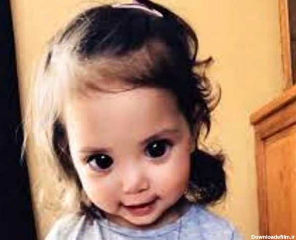 بیماری عجیبی که چشمان این دختر بچه را زیبا کرد (عکس)