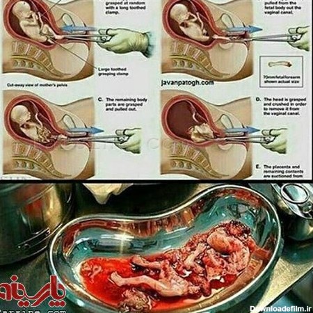 عکس:در سقط جنین عملا چه اتفاقی می افتد؟ +۱۸