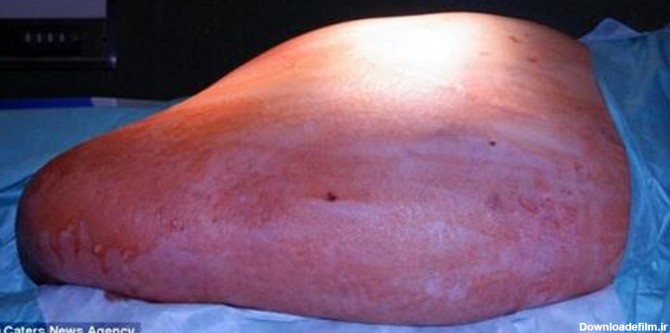 خارج کردن تومور 38 کیلویی از شکم یک زن