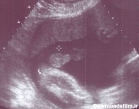 عکس جنین هفت ماهه پسر در شکم مادر