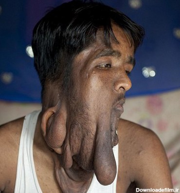 فرارو | (تصویر) بیماری عجیب مرد جوان هندی