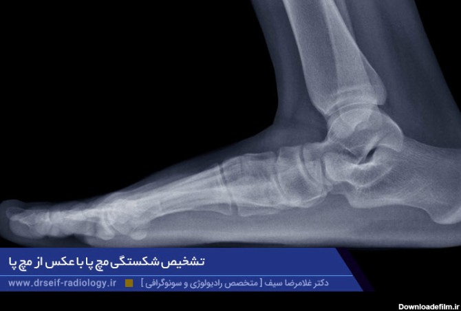 عکس از مچ پا در مرکز سونوگرافی و رادیولوژی شقایق در تهران
