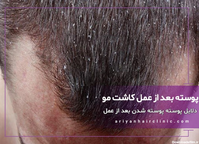 علت پوسته شدن سر بعد از کاشت مو چیست؟