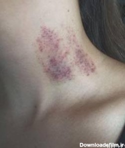 عکس کبودی روی گردن - عکس نودی