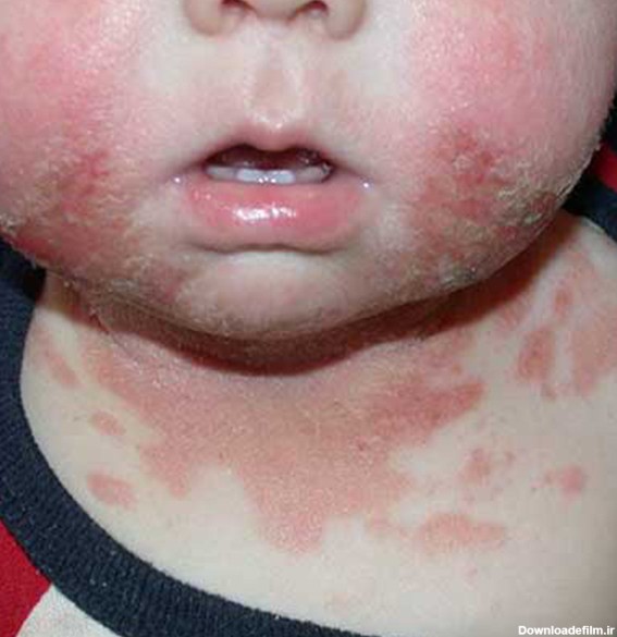 انواع حساسیت پوستی کودکان و نوزادان | علائم، علت و نحوه درمان ...