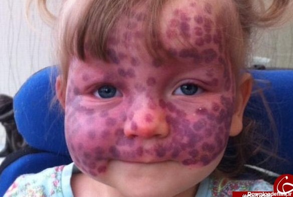 ماه‌گرفتگی نادر روی پوست یک کودک +تصاویر