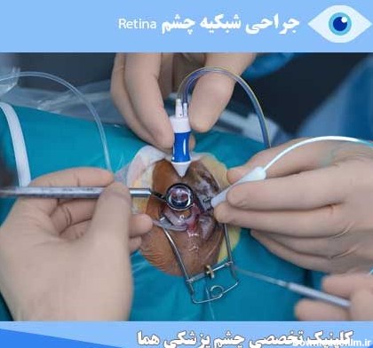 جراحی شبکیه چشم - دکتر منصور همایونی