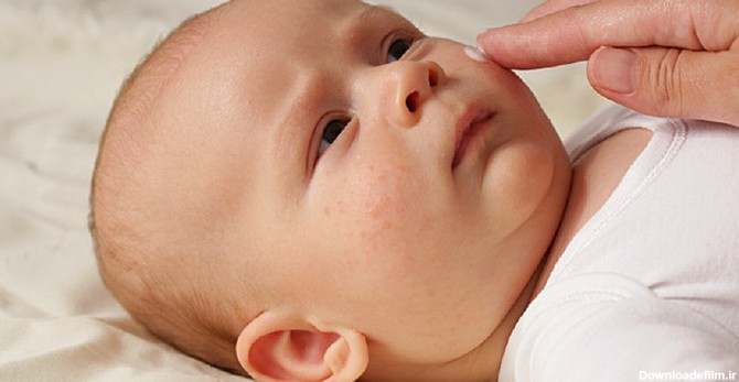 حساسیت پوستی نوزاد با بروز علائمی خود را نشان می دهد