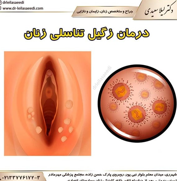 درمان زگیل تناسلی | قطعی ترین روش درمان | دکتر لیلا سعیدی