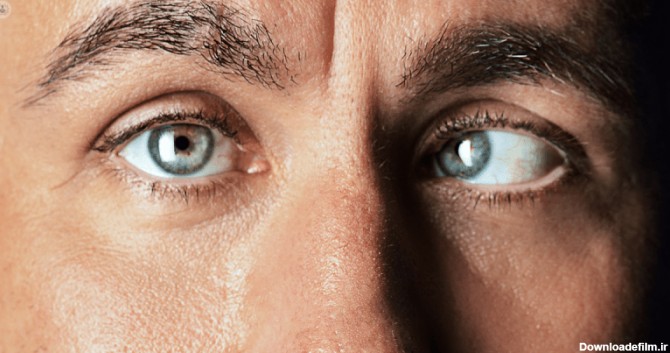 از بیماری انحراف چشم (استرابیسم) چه می دانید