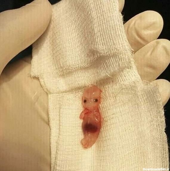عکس بچه یک ماهه سقط شده