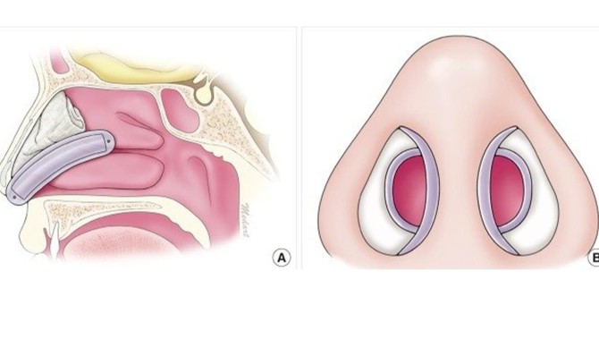 اسپلینت داخل بینی یا تامپون سیلیکونی