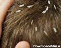 بهترین و سریع ترین روش درمان شپش موی سر