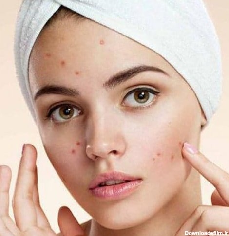 5 روش موثر برای درمان جوش صورت