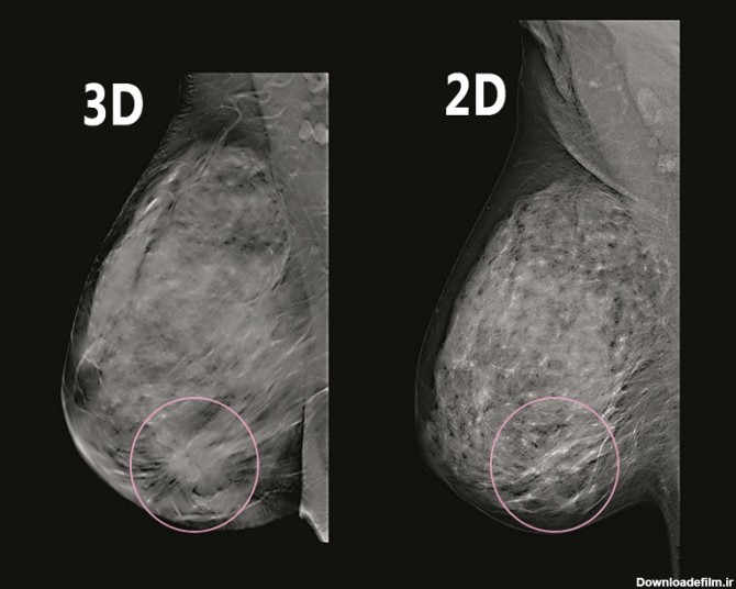 عکس ماموگرافی سرطانی