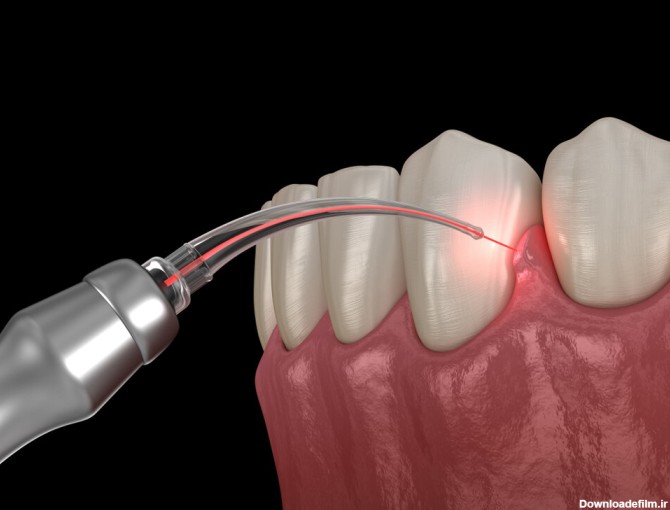 سلاح لیزری برای از بین‌ بردن باکتری‌های دندان!