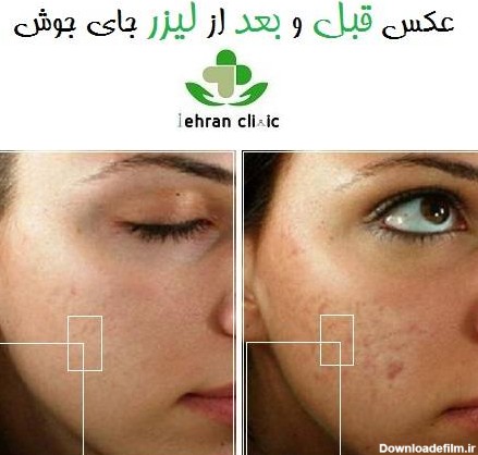 عکس قبل و بعد از لیزر جای جوش