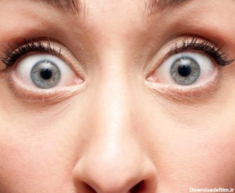 دلایل و درمان بیرون زدگی چشم از حدقه چیست؟ – مجله سلامت دکترتو