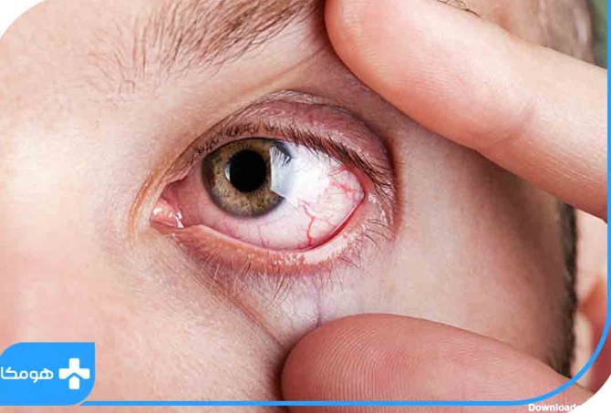 سرطان چشم و علائم آن | مجله هومکا