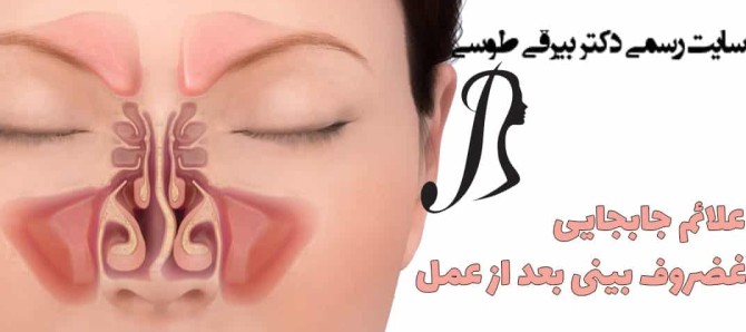 علائم جابجایی غضروف بینی بعد از عمل - سایت رسمی دکتر بیرقی طوسی