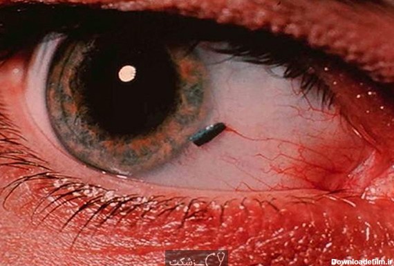 جسم خارجی در چشم || پزشکت