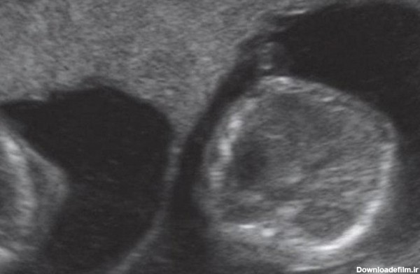 سونوگرافی جنین در هفته چهاردهم بارداری