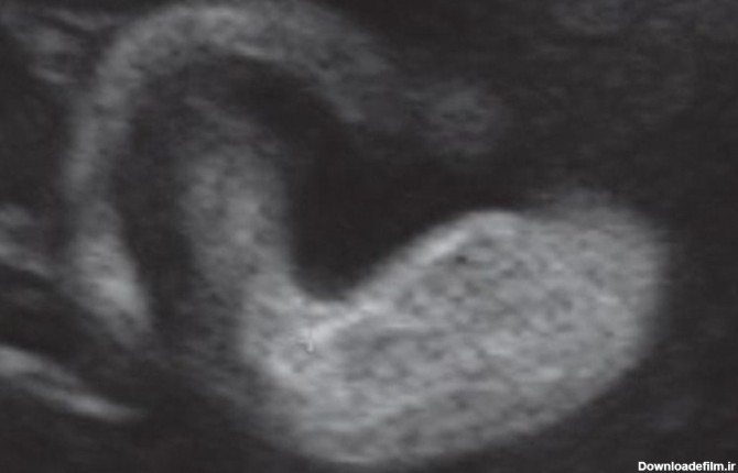 سونوگرافی هفته 34 بارداری