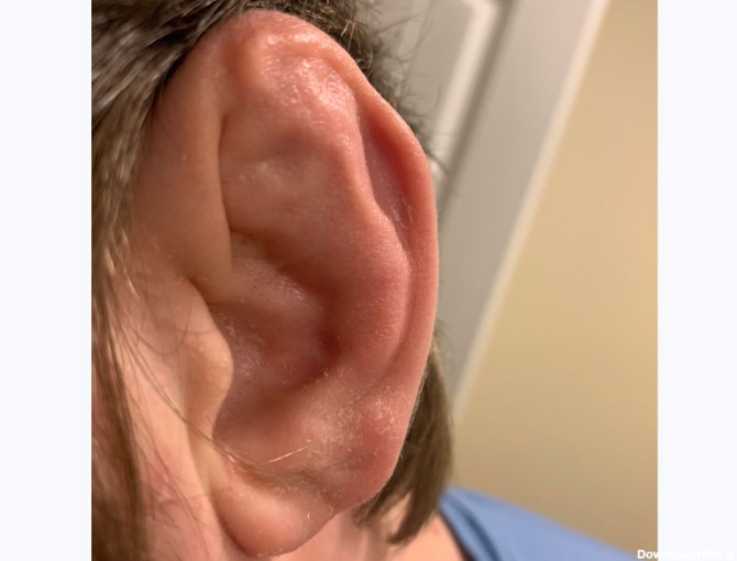 از عوامل خطر گوش گل کلمی از دست دادن شنوایی است.