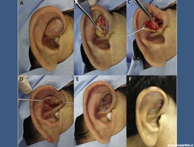 برای تخلیه گوش، پزشک می‌تواند از یک سوزن سوراخ‌دار استفاده کند یا یک برش کوچک ایجاد کند.