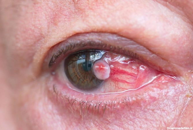 تومورهای ملتحمه چشمی چه آسیبی به سلامت افراد می‌زنند؟