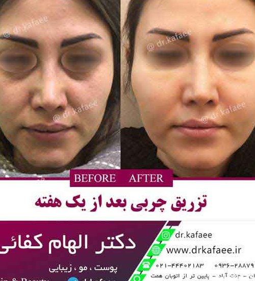 تزریق چربی صورت در تهران - دکتر کفایی