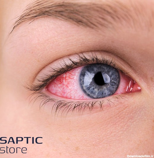 6 مورد از انواع بیماری خطرناک چشمی که ممکن است شما را نابینا ...