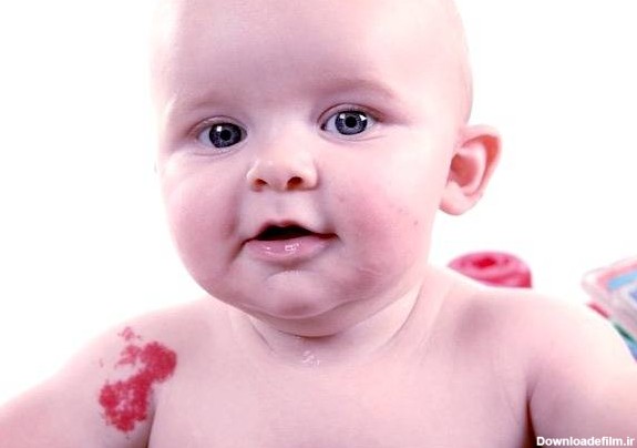 دلیل ماه گرفتگی روی پوست کودکان + انواع ماه گرفتگی نوزاد