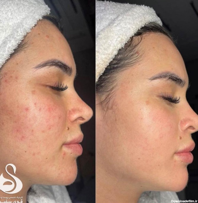 تصاویر قبل و بعد از درمان جوش صورت در کلینیک زیبایی قوی سفید