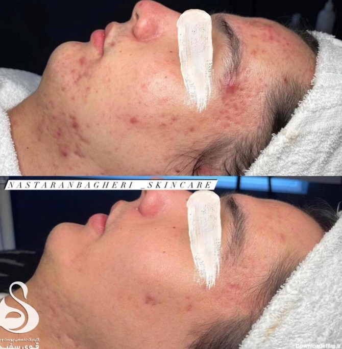 عکس قبل و بعد درمان جوش صورت در کلینیک زیبایی قوی سفید