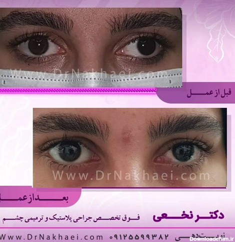 نمونه کار جراحی پلک | بلفاروپلاستی و درمان انحراف چشم - دکتر پریسا ...
