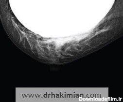 تشخیص توده پستان با ماموگرافی