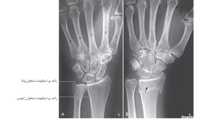 تکنیک های رادیوگرافی مچ دست (1)