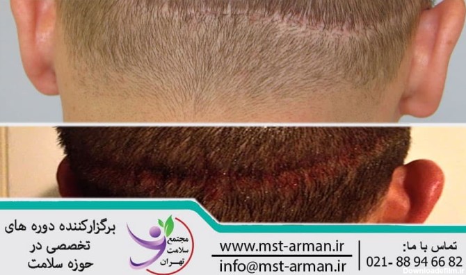 scar in hair transplantation | جای زخم در عمل کاشت مو